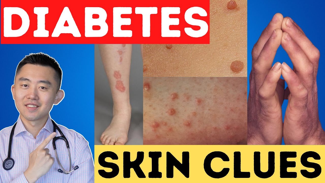 8 Warning Signs of Diabetes and Insulin Resistance That Appear on Your ...